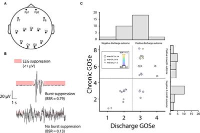 Sedation-Induced Burst Suppression Predicts Positive Outcome Following Traumatic Brain Injury